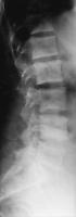 Abbildung 6: Osteoporose - Radiologie