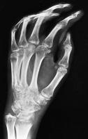 Abbildung 7: Osteoporose - Radiologie