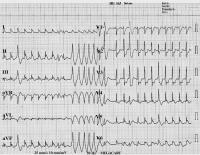 Abbildung 1: EKG