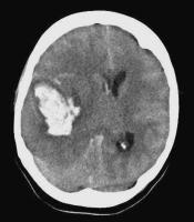 Abbildung 2: Aneurysma