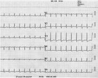 Abbildung 3: Sinusrhythmus