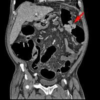 Abbildung 1a: Colon descendens - Tumor