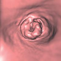 Abbildung 1b: Colon descendens - Tumor