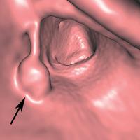 Abbildung 2: Colon sigmoideum - Polyp