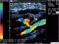 Abbildung 1: Teilthrombosiertes Pseudoaneurysma