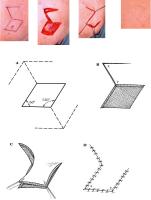 Abbildung 6: Random Flap - Limberg-Lappen