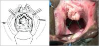 Abbildung 2: Trigonale Fistel - Urethranekrose