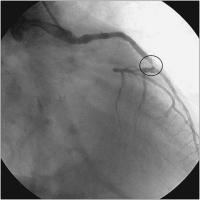 Abbildung 1: Aortokoronarer Venenbypass - RAO-Projektion