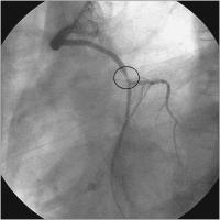 Abbildung 2: Aortokoronarer Venenbypass - LAO-Projektion
