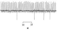 Figure 1: ECG - PMI5 group.