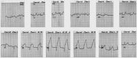 Figure 1: ECG