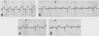 Figure 2: ECG - thrombolysis