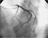 Figure 1: Coronary angiography