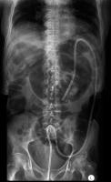 Abbildung 3: Sigmavolvulus