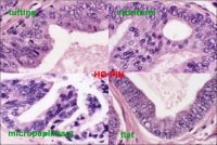 Abbildung 3: Hochgradige prostatische intraepitheliale Neoplasie