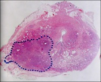Abbildung 1: Prostatakarzinom