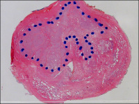 Abbildung 2: Tumor- Transitionalzone