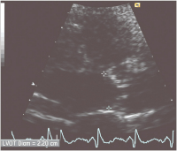 Abbildung 3: LVOT-Diameter