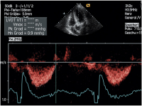 Abbildung 5: LVOT-Gradient