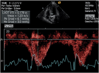 Abbildung 7: LVOT