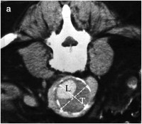 Abbildung 2-a: Abdominelles Aortenaneurysma - CT