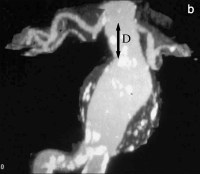 Abbildung 2-b: Abdominelles Aortenaneurysma - CT