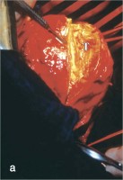 Abbildung 4-a: Abdominelles Aortenaneurysma - Intraoperativ