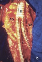 Abbildung 4-b: Abdominelles Aortenaneurysma - Intraoperativ