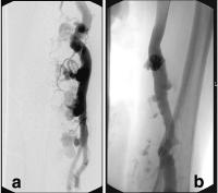 Abbildung 4a-b: Parkes-Weber-Syndrom