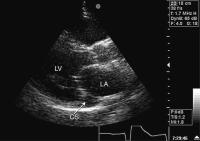 Abbildung 1: Vena cava superior sinistra persistens