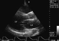 Abbildung 2: Vena cava superior sinistra persistens