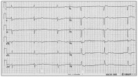 Abbildung 1: EKG