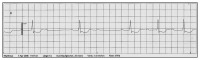 Abbildung 2: EKG