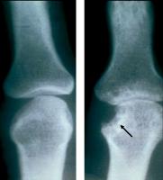 Abbildung 1: Rheumatoide Arthritis - Knochenerosion
