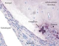Abbildung 2: Rheumatoide Arthritis - Knochenerosion