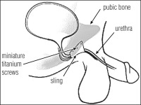 Abbildung 5: In-Vance-System