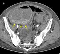 Abbildung 2-a: CT-Enteroklysma
