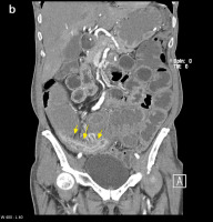 Abbildung 2-b: CT-Enteroklysma