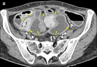 Abbildung 3-a: CT-Enteroklysma