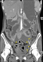 Abbildung 3-b: CT-Enteroklysma