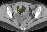 Abbildung 4-a: Morbus Crohn-Rezidiv