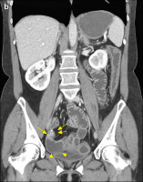 Abbildung 4-b: Morbus Crohn-Rezidiv