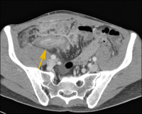 Abbildung 1: MDCT - Ileum