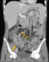 Abbildung 2: Ileum - Mesenterium