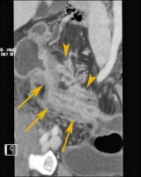 Abbildung 3: Neoterminales Ileum