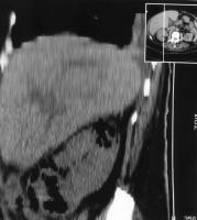 Abbildung 1: Emphysematse Pyelonephritis