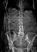 Abbildung 4: Emphysematse Pyelonephritis
