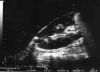 Abbildung 5: Emphysematse Pyelonephritis