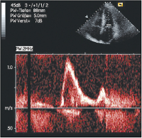 Abbildung 6: Mitralisdoppler