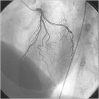 Abbildung 2a: Angiogramm - Koronararterie